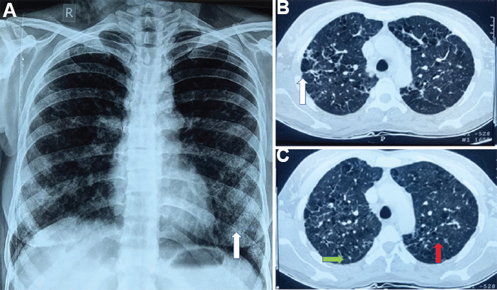 (A) X-ray chest posteroanterior view showing bilateral reticular opacity (white arrow). (B & C) High-resolution computed tomography chest lung window showing septal thickening (green arrow), randomly distributed bizarre cysts (white arrow) and multiple centrilobular nodules (red arrow).